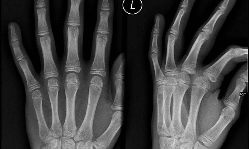 The image depicts an X-Ray of a person's left hand.