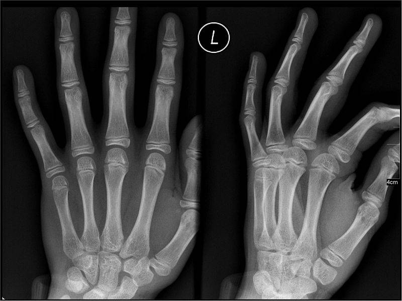 The image depicts an X-Ray of a person's left hand.